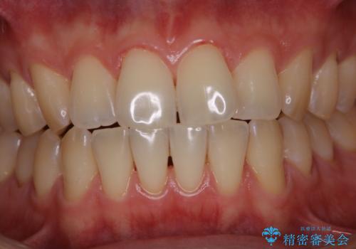 歯のお掃除 PMTCの治療後