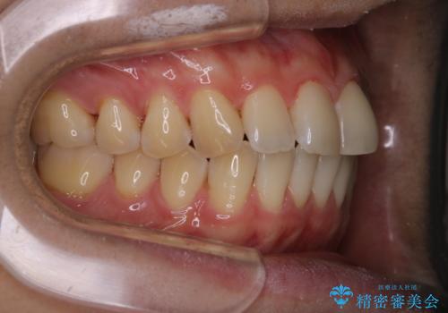 歯のお掃除 PMTCの治療後