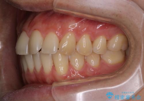 歯のお掃除 PMTCの治療後