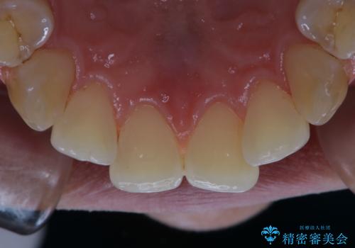 歯のお掃除 PMTCの治療後