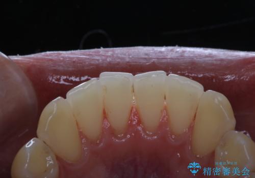 歯のお掃除 PMTCの治療後