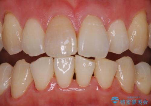 歯科医院で専門的なクリーニング PMTCの症例 治療後