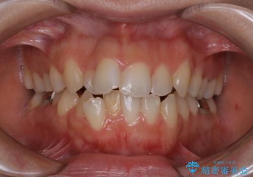 歯科矯正治療前のクリーニング　PMTCの症例 治療前