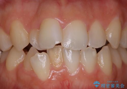 歯科矯正治療前のクリーニング PMTCの治療前