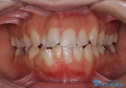 歯科矯正治療前のクリーニング　PMTCの症例 治療後