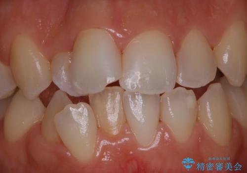 歯科矯正治療前のクリーニング　PMTCの治療後