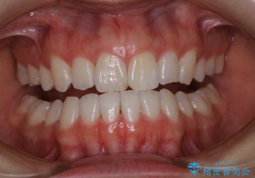 オフィスホワイトニング スペシャル2回照射の症例 治療前