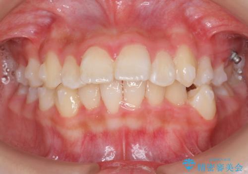 中学生のマウスピース矯正 歯を抜かずにキレイにの治療中