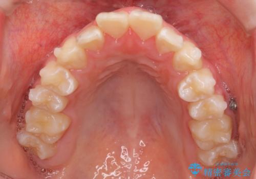 中学生のマウスピース矯正 歯を抜かずにキレイにの治療中