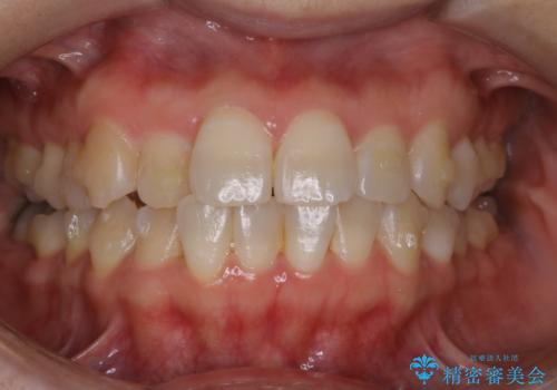 invisalign矯正治療中のPMTC クリーニングの治療前