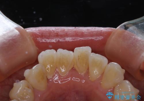 Orthodontics中にPMTCで綺麗にクリーニングの症例 治療前