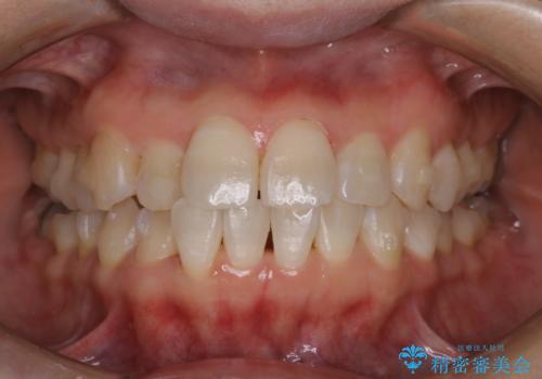 invisalign矯正治療中のPMTC クリーニングの治療後