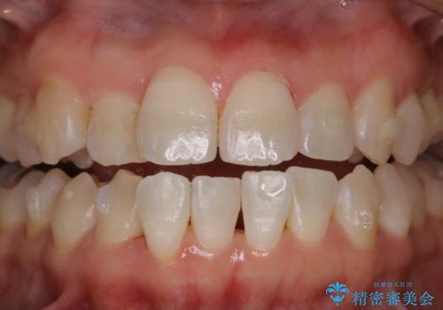 invisalign矯正治療中のPMTC クリーニングの症例 治療後