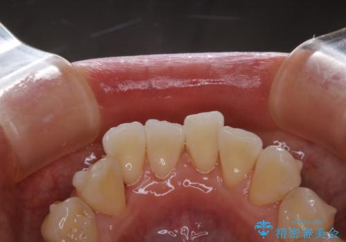 Orthodontics中にPMTCで綺麗にクリーニングの症例 治療後