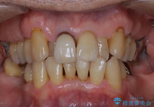 インプラントの2次OPE前にPMTCの治療前