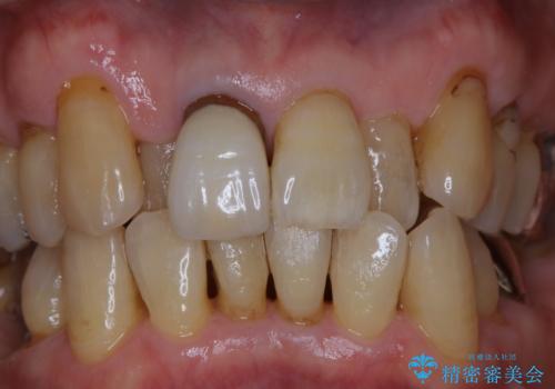 インプラントの2次OPE前にPMTCの治療前