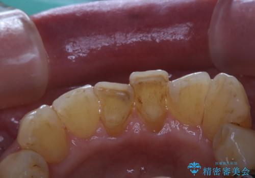 インプラントの2次OPE前にPMTC