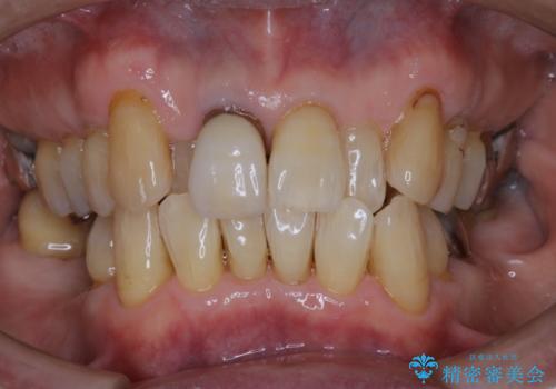 インプラントの2次OPE前にPMTCの治療後