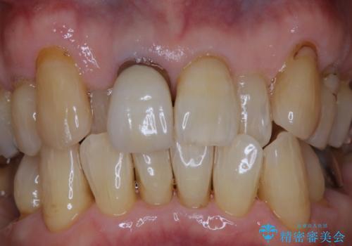 インプラントの2次OPE前にPMTCの治療後