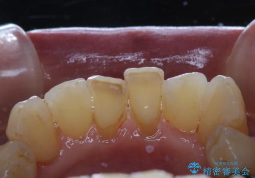 インプラントの2次OPE前にPMTCの症例 治療後