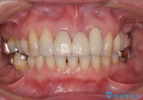 ブリッジの土台が割れて痛い インプラントによる補綴治療の治療前