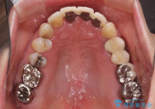 ブリッジの土台が割れて痛い インプラントによる補綴治療の治療前