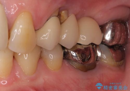 ブリッジの土台が割れて痛い インプラントによる補綴治療の治療前
