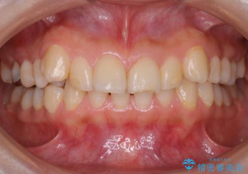 【ワイヤー矯正】前歯が出てるのをなおしたい。の治療前