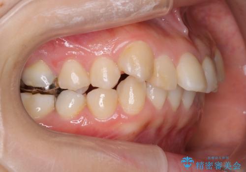 【ワイヤー矯正】前歯が出てるのをなおしたい。の治療前