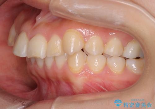 【ワイヤー矯正】前歯が出てるのをなおしたい。の治療前