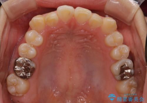 【ワイヤー矯正】前歯が出てるのをなおしたい。の治療前