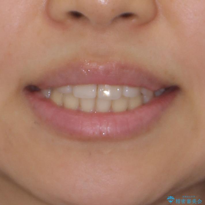前歯の突出感とデコボコ　インビザラインで改善の治療後（顔貌）