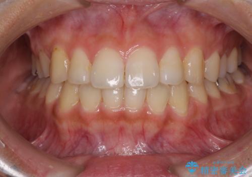 前歯の突出感とデコボコ　インビザラインで改善の治療後
