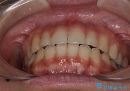 前歯の突出感とデコボコ インビザラインで改善の治療後