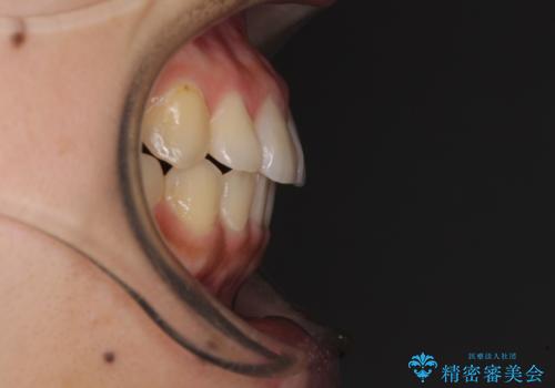 前歯の突出感とデコボコ インビザラインで改善の治療後