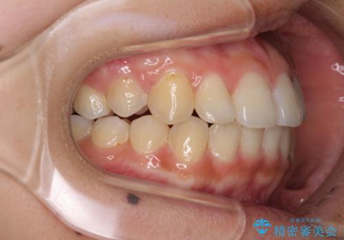 前歯の突出感とデコボコ インビザラインで改善の治療後