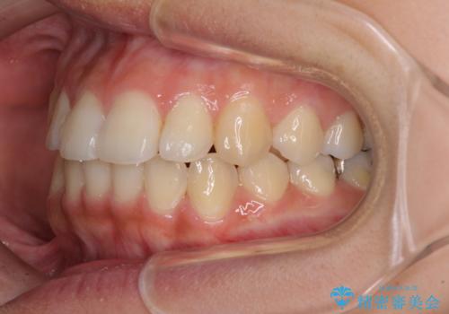 前歯の突出感とデコボコ インビザラインで改善の治療後