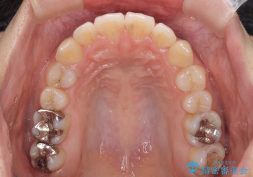 前歯の突出感とデコボコ インビザラインで改善の治療後