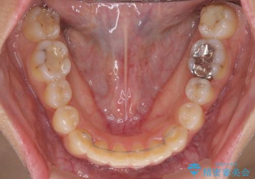 前歯の突出感とデコボコ　インビザラインで改善の治療後
