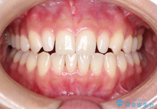 【矮小歯】ダイレクトボンディングによる歯冠修復の治療前