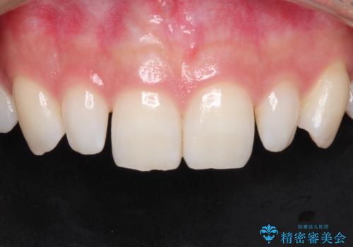 【矮小歯】ダイレクトボンディングによる歯冠修復の治療前