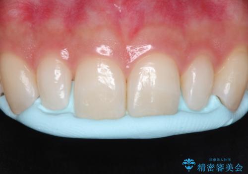 【矮小歯】ダイレクトボンディングによる歯冠修復の治療中