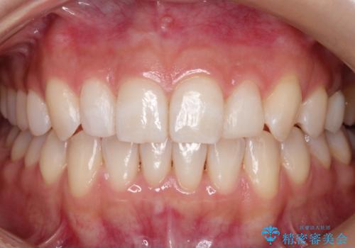 【矮小歯】ダイレクトボンディングによる歯冠修復の治療後