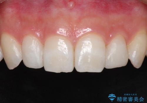 【矮小歯】ダイレクトボンディングによる歯冠修復