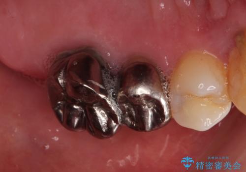 金属のかぶせ物をセラミックへ 根管治療からの再治療の治療前