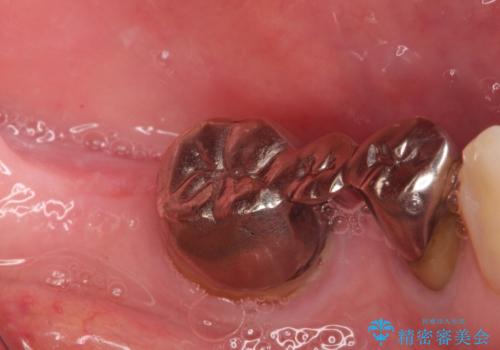 金属のかぶせ物をセラミックへ 根管治療からの再治療の治療前
