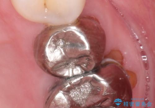 金属のかぶせ物をセラミックへ 根管治療からの再治療の治療前
