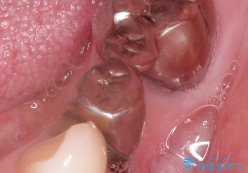 金属のかぶせ物をセラミックへ 根管治療からの再治療の治療前