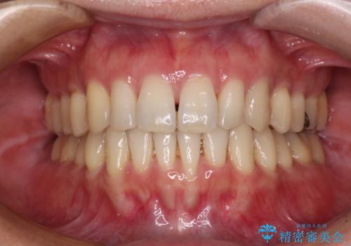 八重歯のインビザライン矯正治療の症例 治療後