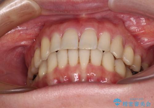 八重歯のインビザライン矯正治療の治療後